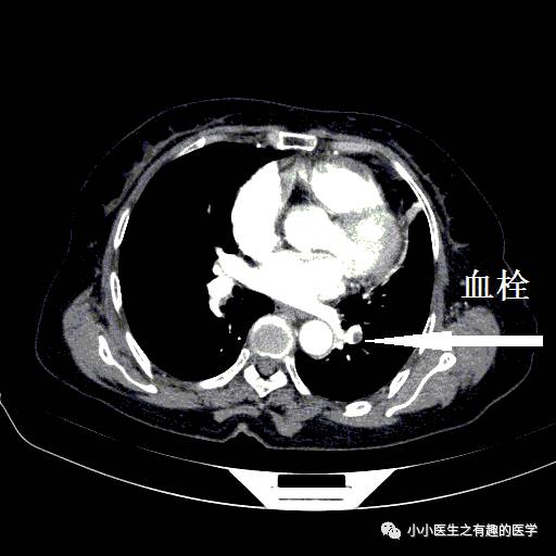 肺栓塞CT轻松入门
