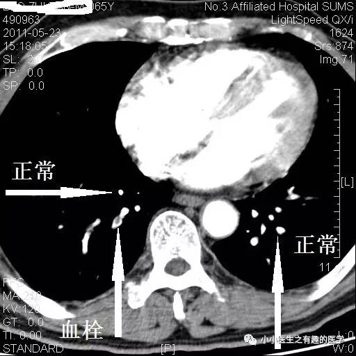 肺栓塞CT轻松入门