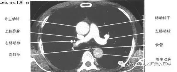 肺栓塞CT轻松入门