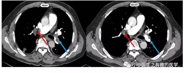 肺栓塞CT轻松入门