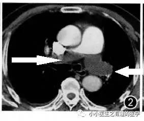 肺栓塞CT轻松入门