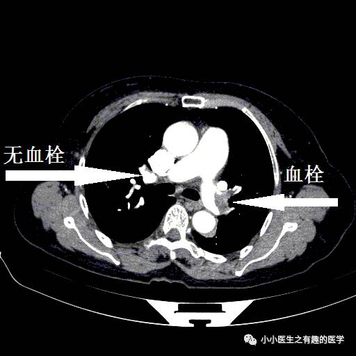 肺栓塞CT轻松入门