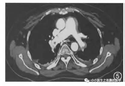 肺栓塞CT轻松入门