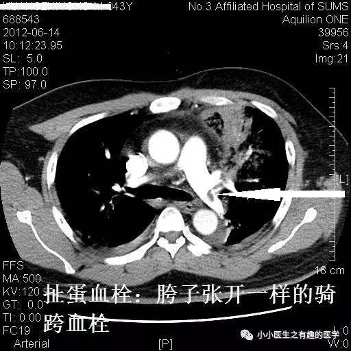 肺栓塞CT轻松入门