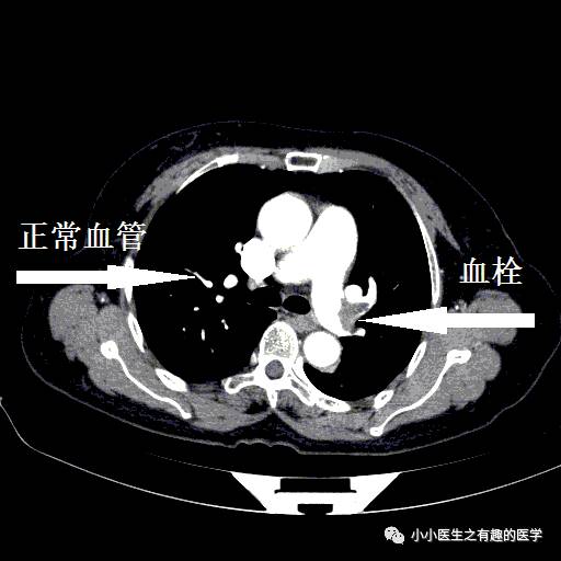 肺栓塞CT轻松入门