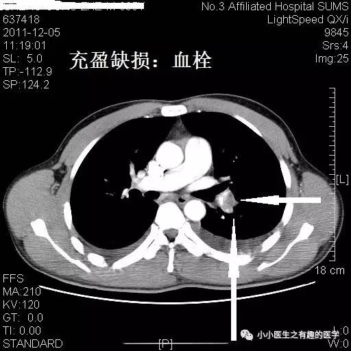 肺栓塞CT轻松入门