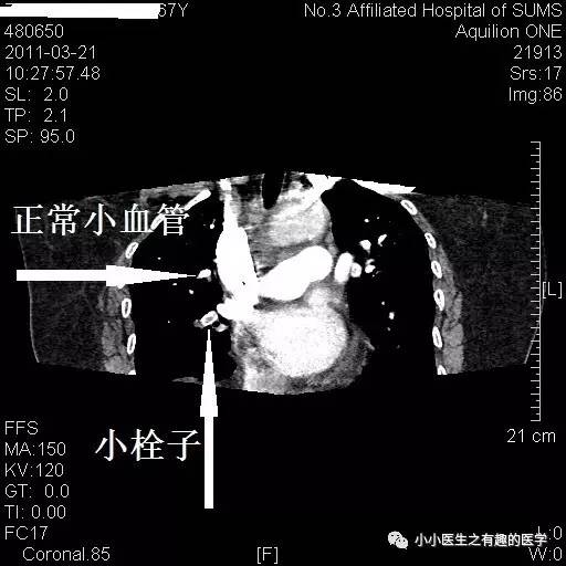 肺栓塞CT轻松入门