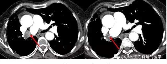肺栓塞CT轻松入门