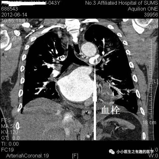 肺栓塞CT轻松入门