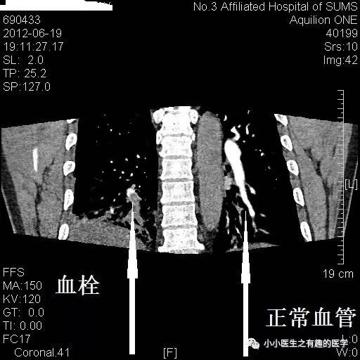 肺栓塞CT轻松入门