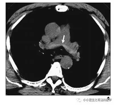 肺栓塞提高篇：CT平扫可发现、甚至诊断肺栓塞，看看国外高手论肺栓塞