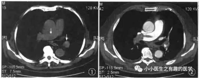 肺栓塞提高篇：CT平扫可发现、甚至诊断肺栓塞，看看国外高手论肺栓塞
