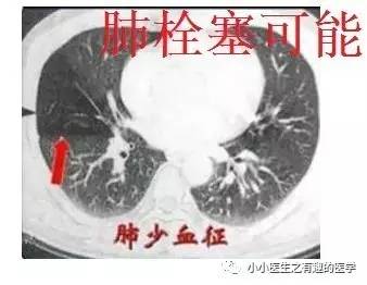 肺栓塞提高篇：CT平扫可发现、甚至诊断肺栓塞，看看国外高手论肺栓塞