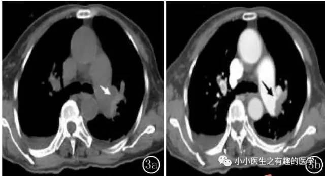 肺栓塞提高篇：CT平扫可发现、甚至诊断肺栓塞，看看国外高手论肺栓塞