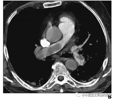 肺栓塞提高篇：CT平扫可发现、甚至诊断肺栓塞，看看国外高手论肺栓塞