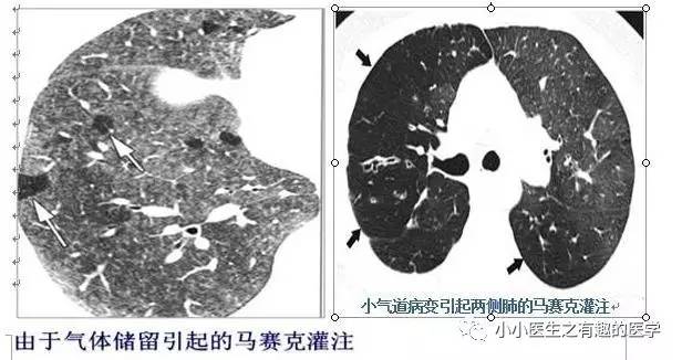 肺栓塞提高篇：CT平扫可发现、甚至诊断肺栓塞，看看国外高手论肺栓塞