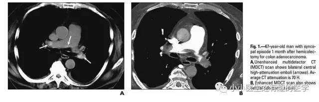 肺栓塞提高篇：CT平扫可发现、甚至诊断肺栓塞，看看国外高手论肺栓塞