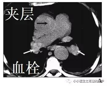 肺栓塞提高篇：CT平扫可发现、甚至诊断肺栓塞，看看国外高手论肺栓塞