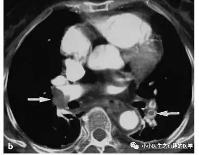肺栓塞提高篇：CT平扫可发现、甚至诊断肺栓塞，看看国外高手论肺栓塞