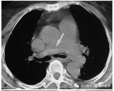 肺栓塞提高篇：CT平扫可发现、甚至诊断肺栓塞，看看国外高手论肺栓塞