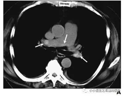 肺栓塞提高篇：CT平扫可发现、甚至诊断肺栓塞，看看国外高手论肺栓塞