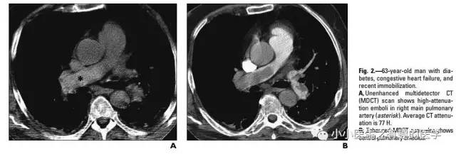 肺栓塞提高篇：CT平扫可发现、甚至诊断肺栓塞，看看国外高手论肺栓塞