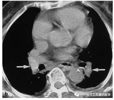肺栓塞提高篇：CT平扫可发现、甚至诊断肺栓塞，看看国外高手论肺栓塞