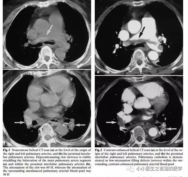 肺栓塞提高篇：CT平扫可发现、甚至诊断肺栓塞，看看国外高手论肺栓塞