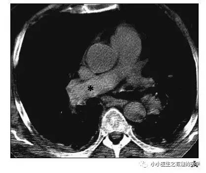 肺栓塞提高篇：CT平扫可发现、甚至诊断肺栓塞，看看国外高手论肺栓塞