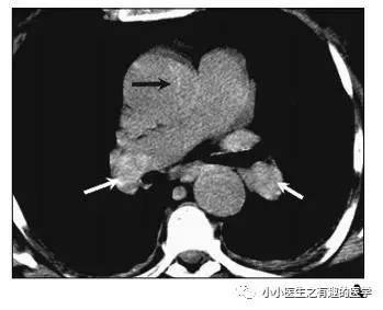 肺栓塞提高篇：CT平扫可发现、甚至诊断肺栓塞，看看国外高手论肺栓塞