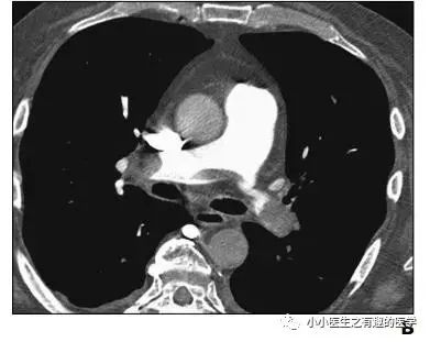 肺栓塞提高篇：CT平扫可发现、甚至诊断肺栓塞，看看国外高手论肺栓塞