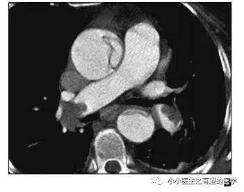 肺栓塞提高篇：CT平扫可发现、甚至诊断肺栓塞，看看国外高手论肺栓塞