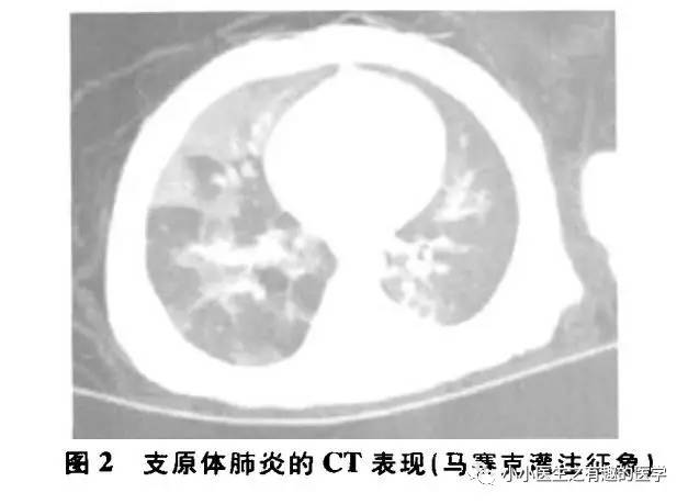 肺栓塞提高篇：CT平扫可发现、甚至诊断肺栓塞，看看国外高手论肺栓塞
