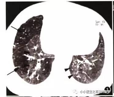 肺栓塞提高篇：CT平扫可发现、甚至诊断肺栓塞，看看国外高手论肺栓塞
