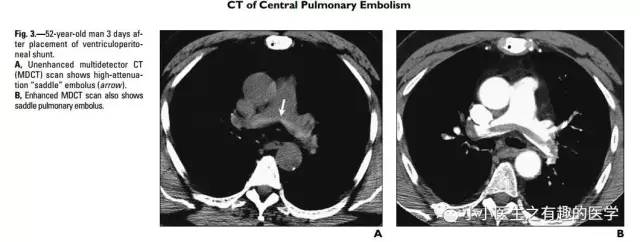 肺栓塞提高篇：CT平扫可发现、甚至诊断肺栓塞，看看国外高手论肺栓塞