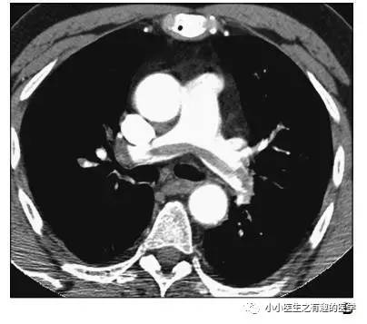 肺栓塞提高篇：CT平扫可发现、甚至诊断肺栓塞，看看国外高手论肺栓塞