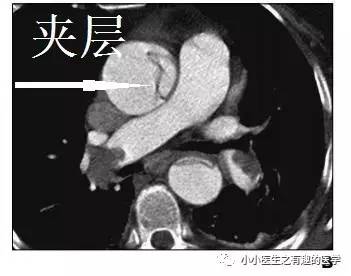 肺栓塞提高篇：CT平扫可发现、甚至诊断肺栓塞，看看国外高手论肺栓塞