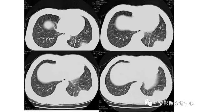 【病例】胸膜结核瘤1例CT影像表现