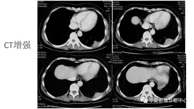 【病例】胸膜结核瘤1例CT影像表现