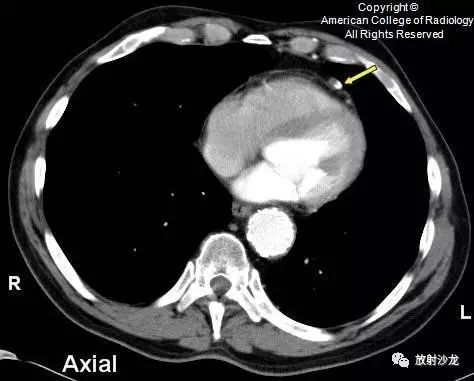 【病例】心包脂肪坏死一例CT