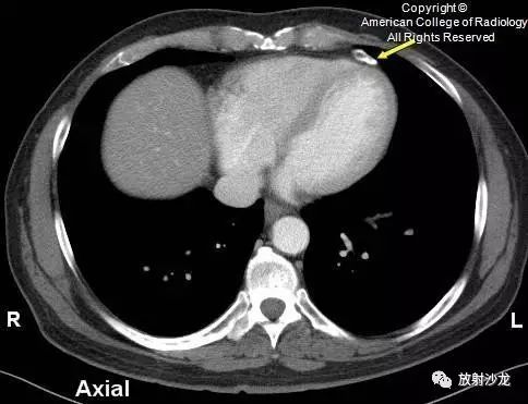 【病例】心包脂肪坏死一例CT
