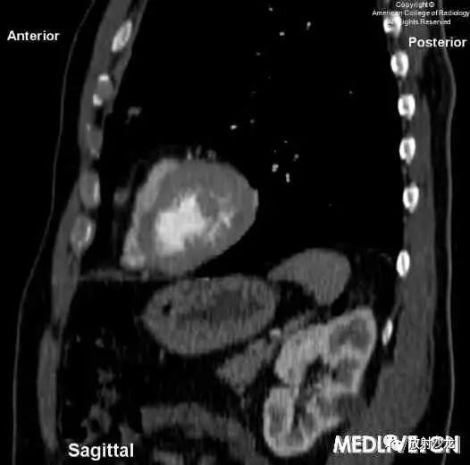【病例】心包脂肪坏死一例CT