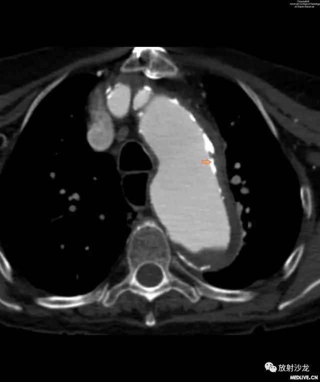 【病例】主动脉壁内血肿1例CT影像表现