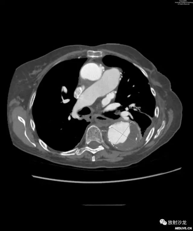 【病例】主动脉壁内血肿1例CT影像表现