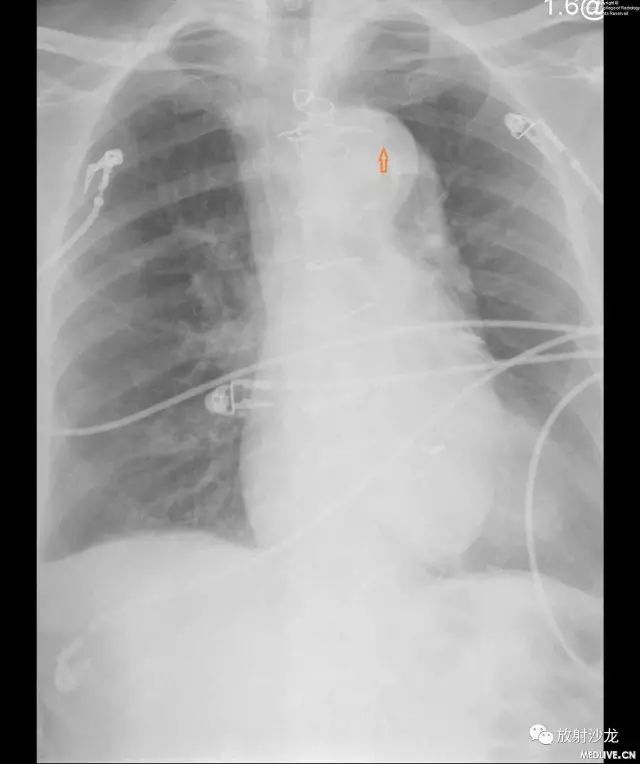 【病例】主动脉壁内血肿1例CT影像表现