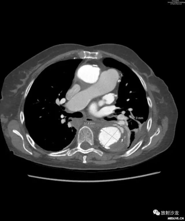 【病例】主动脉壁内血肿1例CT影像表现