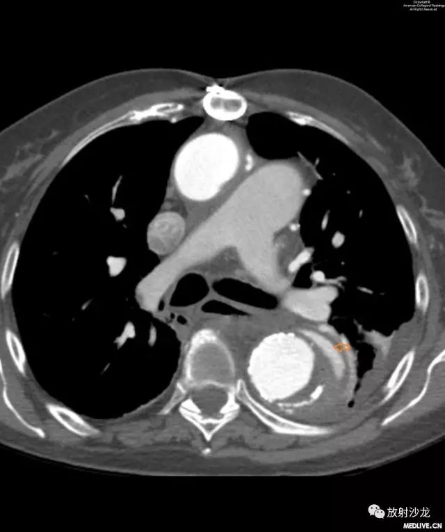 【病例】主动脉壁内血肿1例CT影像表现