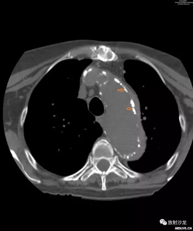 【病例】主动脉壁内血肿1例CT影像表现