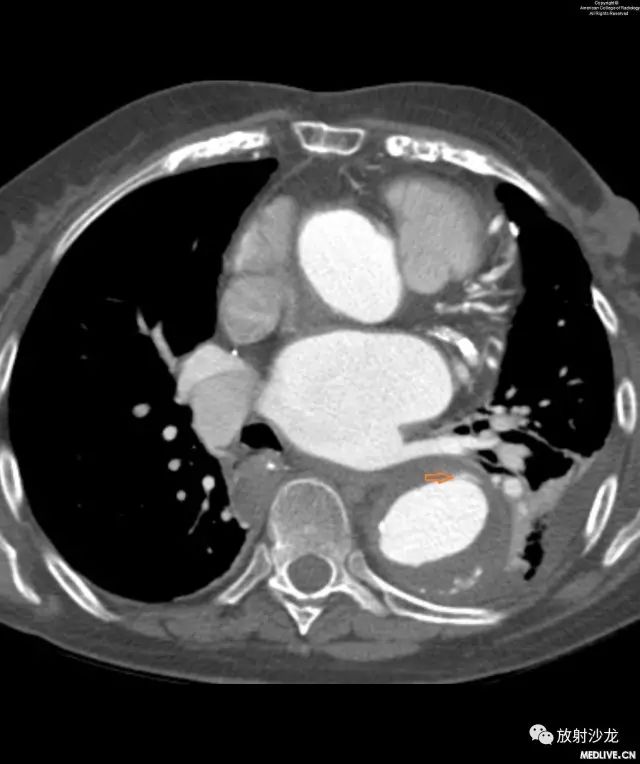 【病例】主动脉壁内血肿1例CT影像表现