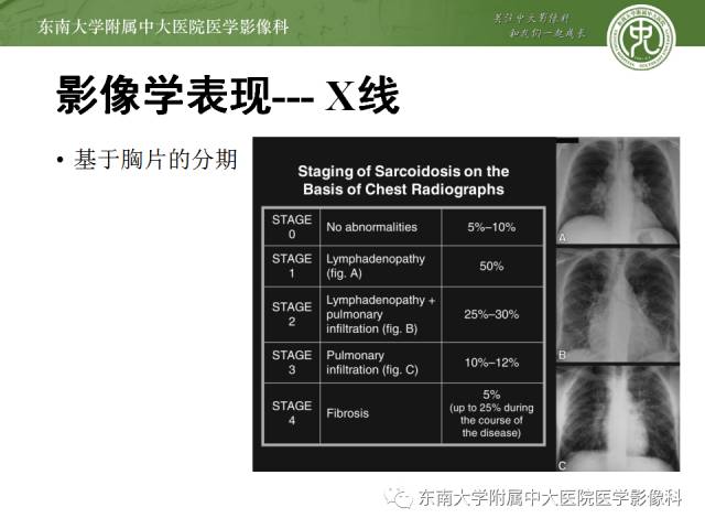 【病例】结节病1例CT